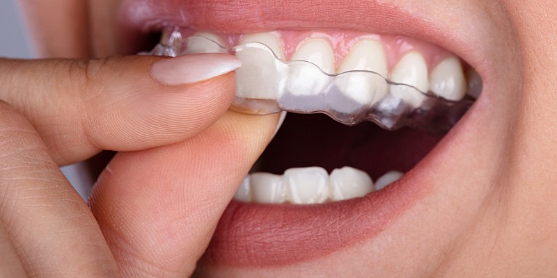Aligner